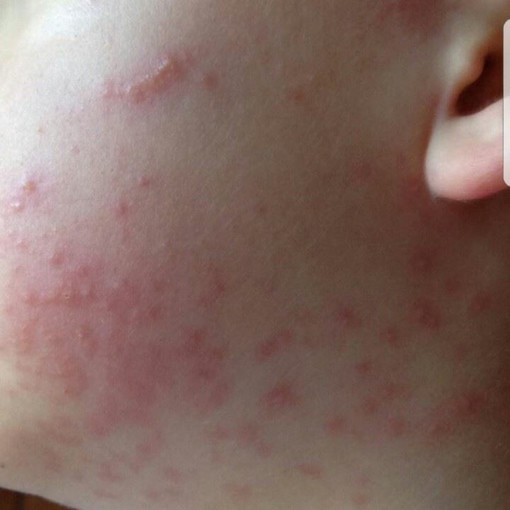 Reazioni allergiche sui bambini nelle scuole savonesi causa processionaria, la denuncia dei genitori: "ATA ha ritardato la disinfestazione"