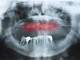 Parodontite e perdita dei denti. Come riavere denti fissi con l’implantologia