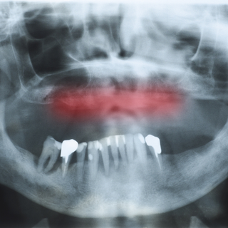 Parodontite e perdita dei denti. Come riavere denti fissi con l’implantologia