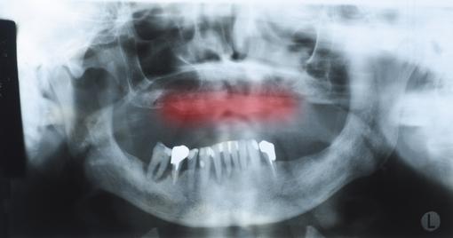 Parodontite e perdita dei denti. Come riavere denti fissi con l’implantologia Parodontite e perdita dei denti. Come riavere denti fissi con l’implantologia