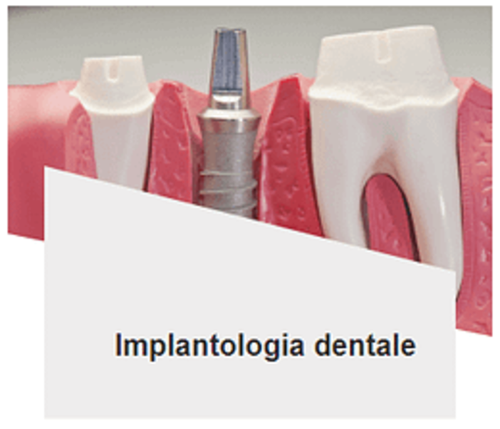 Impianti dentali: la soluzione definitiva per i denti mancanti Impianti dentali: la soluzione definitiva per i denti mancanti