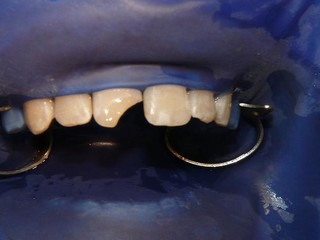 " Incisivo fratturato di un ragazzino, conseguenza di una caduta in bici, isolato con la diga durante la ricostruzione. In questo modo il materiale può essere "incollato ad dente" in maniera ottimale".