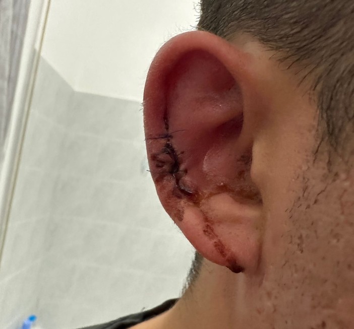Lite in discoteca, aggressore stacca il lobo dell'orecchio ad un giovane di Arma di Taggia Lite in discoteca, aggressore stacca il lobo dell'orecchio ad un giovane di Arma di Taggia