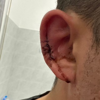 Lite in discoteca, aggressore stacca il lobo dell'orecchio ad un giovane di Arma di Taggia Lite in discoteca, aggressore stacca il lobo dell'orecchio ad un giovane di Arma di Taggia