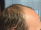 Trapianto di capelli in Turchia o in Spagna? Trapianto di capelli in Turchia o in Spagna?