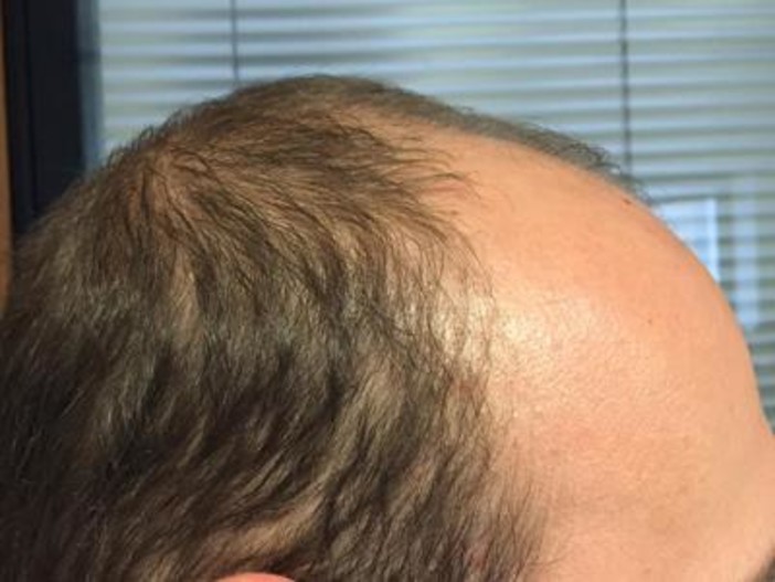 Trapianto di capelli in Turchia o in Spagna? Trapianto di capelli in Turchia o in Spagna?