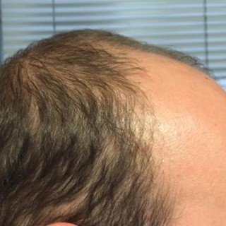 Trapianto di capelli in Turchia o in Spagna?