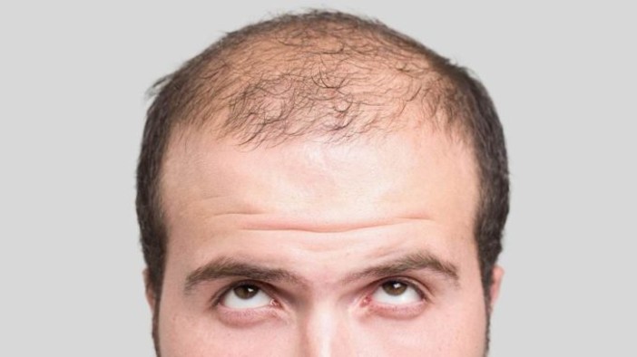 Perdita di capelli, quali sono le cause più comuni?