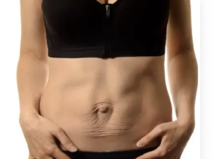 Cos’è la diastasi addominale