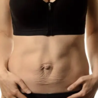 Cos’è la diastasi addominale