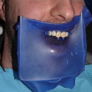Diga per denti: aiutatemi a capire se è davvero così