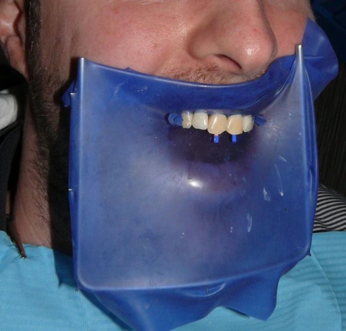 Diga per denti: aiutatemi a capire se è davvero così Diga per denti: aiutatemi a capire se è davvero così
