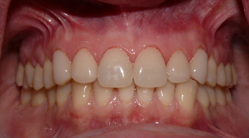 Faccette dentali ecco come avere un sorriso perfetto Faccette dentali ecco come avere un sorriso perfetto