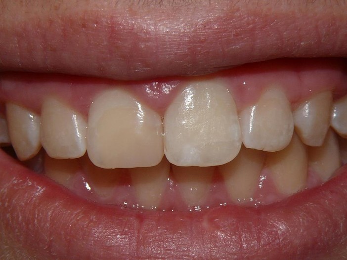 il dente ricostruito in materiale estetico, ripristinato "a prova di panino"!"