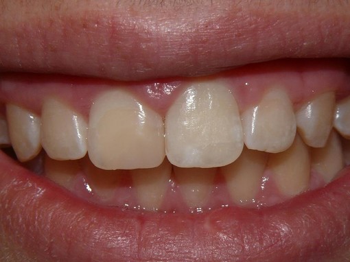 il dente ricostruito in materiale estetico, ripristinato "a prova di panino"!"