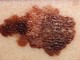 Loano, prevenzione del melanoma: aperte le prenotazioni per le visite dermatologiche gratuite Loano, prevenzione del melanoma: aperte le prenotazioni per le visite dermatologiche gratuite