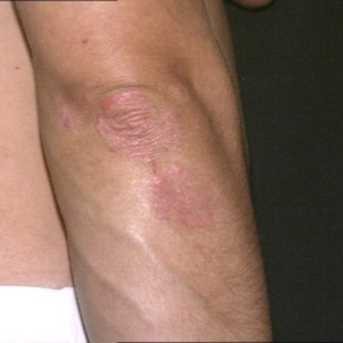 Più di 63mila malati di psoriasi in Liguria: il 28 ottobre ospedali aperti per visite gratuite