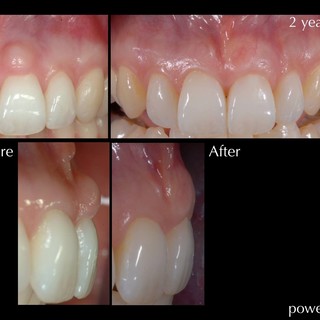 Scopriamo la tecnica della chirurgia estetica delle gengive
