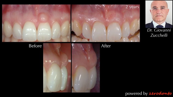 Scopriamo la tecnica della chirurgia estetica delle gengive Scopriamo la tecnica della chirurgia estetica delle gengive