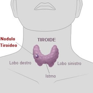 Albenga, visite gratuite per la prevenzione dei tumori della tiroide con ANT