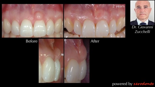 Scopriamo la tecnica della chirurgia estetica delle gengive Scopriamo la tecnica della chirurgia estetica delle gengive