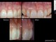 Scopriamo la tecnica della chirurgia estetica delle gengive Scopriamo la tecnica della chirurgia estetica delle gengive