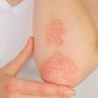Giornata psoriasi, Ucb rinnova l'impegno contro lo stigma Giornata psoriasi, Ucb rinnova l'impegno contro lo stigma