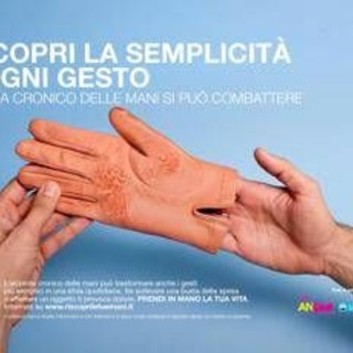 Mani che bruciano e fanno male, al via campagna su eczema cronico Mani che bruciano e fanno male, al via campagna su eczema cronico