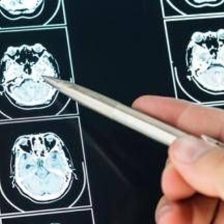 Ecco come il Long Covid cambia il cervello con meccanismi tipici dell'Alzheimer