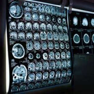 Giornata mondiale delle malattie rare, Sin rafforza impegno per patologie neurologiche Giornata mondiale delle malattie rare, Sin rafforza impegno per patologie neurologiche