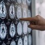 Malattia di Parkinson, ok in Europa a formulazione orale Ld/Cd a rilascio modificato Malattia di Parkinson, ok in Europa a formulazione orale Ld/Cd a rilascio modificato