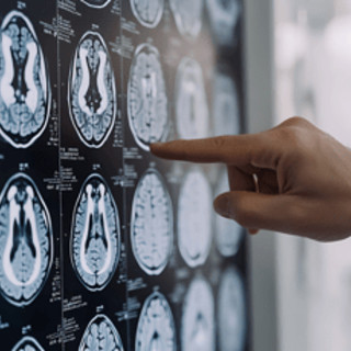 Neurologi: "Per tumori cerebrali la svolta della medicina di precisione"