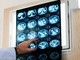 Nodulo polmonare: che cos’è, come si diagnostica e quando intervenire