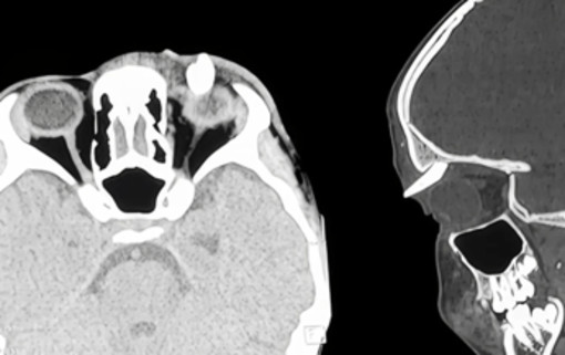Ha un gonfiore sotto l'occhio, in ospedale scoprono che ha un dente nella palpebra: lo strano caso in India Ha un gonfiore sotto l'occhio, in ospedale scoprono che ha un dente nella palpebra: lo strano caso in India
