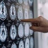 Stop tremori Parkinson senza bisturi, 10 pazienti curati con ultrasuoni a Napoli Stop tremori Parkinson senza bisturi, 10 pazienti curati con ultrasuoni a Napoli