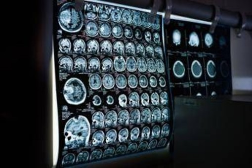 Giornata mondiale delle malattie rare, Sin rafforza impegno per patologie neurologiche Giornata mondiale delle malattie rare, Sin rafforza impegno per patologie neurologiche