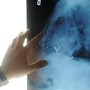 Radiologia interventistica, Ssn e fondazioni per cure più accessibili Radiologia interventistica, Ssn e fondazioni per cure più accessibili